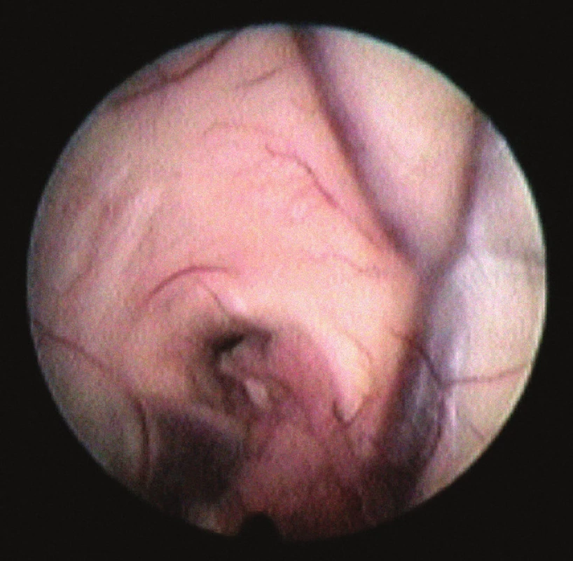 Endoskopický pohled na odkryté foramen Monroe.