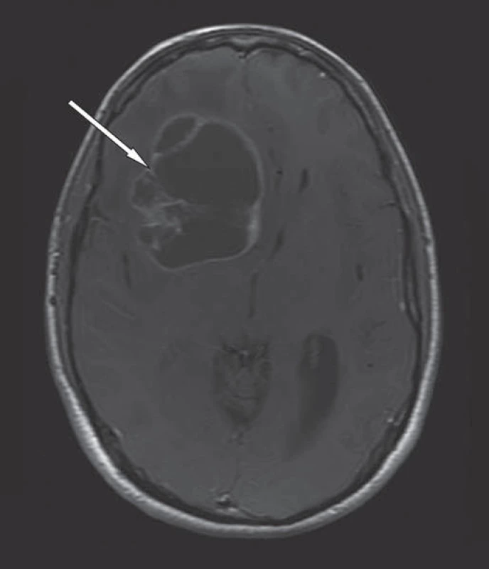 MR mozku v T1W obraze, axiální rovina, po podání k. l.
