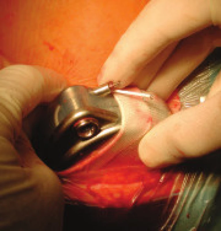 Implantace pumpy Synchromed II v dakronovém vaku do podkožní kapsy na břiše. Na konci intratékálně zavedeného katétru je vidět kapka likvoru.
