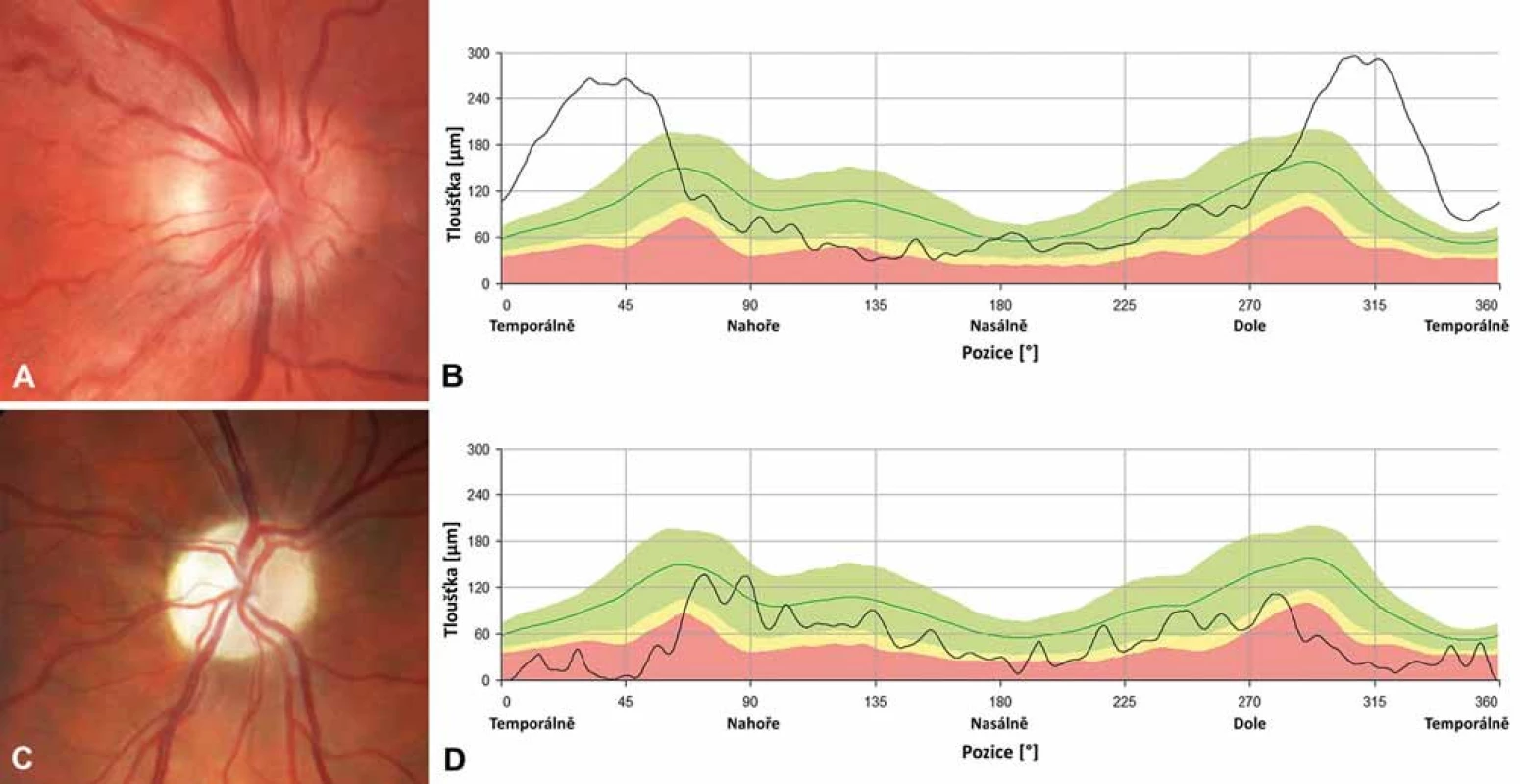Nálezy na terčích zrakového nervu u dvou pacientů s LHON.
Barevná fotografie papily zrakového nervu pravého oka 20letého muže s m.11778G&gt;A mutací v době akutní fáze onemocnění, lze pozorovat pseudoedém a vinuté, rozšířené cévy při okraji (A); měření tloušťky vrstvy nervových vláken (RNFL) peripapilárně dokládá zvýšení nad normativní databázi (zelené pásmo) temporálně, zatímco nazálně a nahoře lze již detekovat počínající atrofii (žluté a červené pásmo) (B). Barevná fotografie papily zrakového nervu pravého oka 26letého muže s m.11778G&gt;A 6 let po manifestaci onemocnění, terč je výrazně bledý, což odpovídá těžké atrofii (C); měření RNFL dokládá úbytek této vrstvy, hodnoty jsou převážně patologické nebo hraniční (červené a žluté pásmo), dále dochází ke ztrátě charakteristické dvojitě vlnité kontury křivky (zelená linie) (D).
Fig. 3. Optic nerve heads findings in two patients with LHON.
Colour photograph of the right optic disc of a 20-year-old male with m.11778G&gt;A mutation in acute disease stage showing pseudoedema, telangiectasia and increased tortuosity of retinal vessels (A); peripapillary retinal nerve fibre layer measurements show increased thickness above the normative database (green band) temporally while in the nasal and superior quadrants there is already a RNFL thickness reduction (yellow and red band) (B). Colour photograph of the right optic nerve head of a 26-year-old male with m.11778G&gt;A mutation 6 years after the disease onset, the disc is pale corresponding to severe atrophy (C); RNFL measurements confirm thinning, most values are within the pathological or borderline range (red and yellow band), the typical normal pattern of RNFL striations is absent (green line) (D).