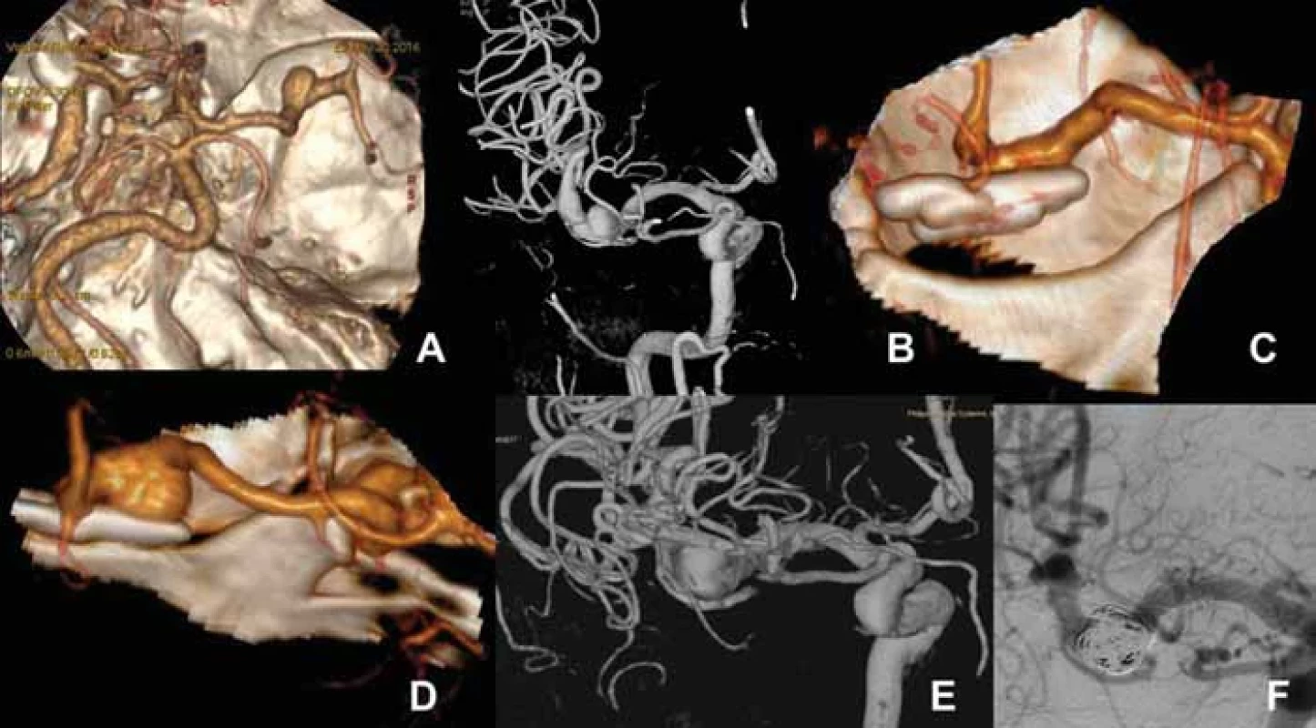 (A) Vstupní 3D CTA mozkových tepen u 59letého kuřáka s arteriální hypertenzí provedené pro kolapsový stav s nálezem incidentálního aneuryzmatu M1 vlevo 7 mm. (B) 3D DSA verifi kující aneuryzma úseku M1 vlevo a fusiformní dilataci jedné z větví M2 vlevo. (C) 3D CTA po klipu aneuryzmatu (rok 2016). Perioperačně se ukázalo, že se jedná o sakulární aneuryzma se širokým krčkem nežli o fuziformní cévní výduť. (D) Kontrolní CTA po 4 letech (2020) prokázala recidivu aneuryzmatu o velikosti 10 mm, což verifi kovala i následná DSA (E). (F) Angiografi e na konci endovaskulární embolizace recidivy aneuryzmatu pomocí spirálek a stentu (jehož spirálky jsou patrné v M1 segmentu).