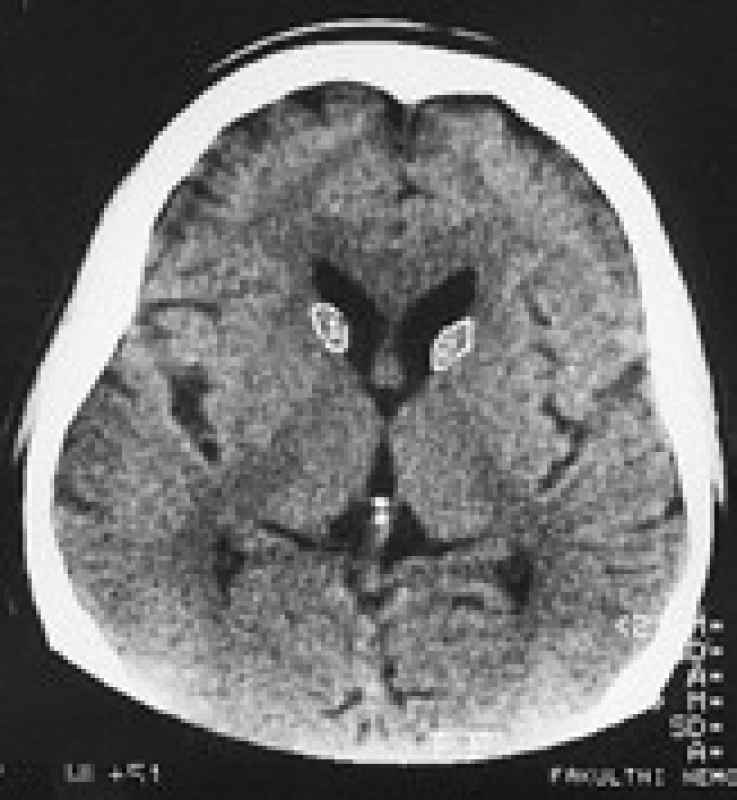 Planimetrie caput nuclei caudati u pacienta s McLeodovým syndromem.