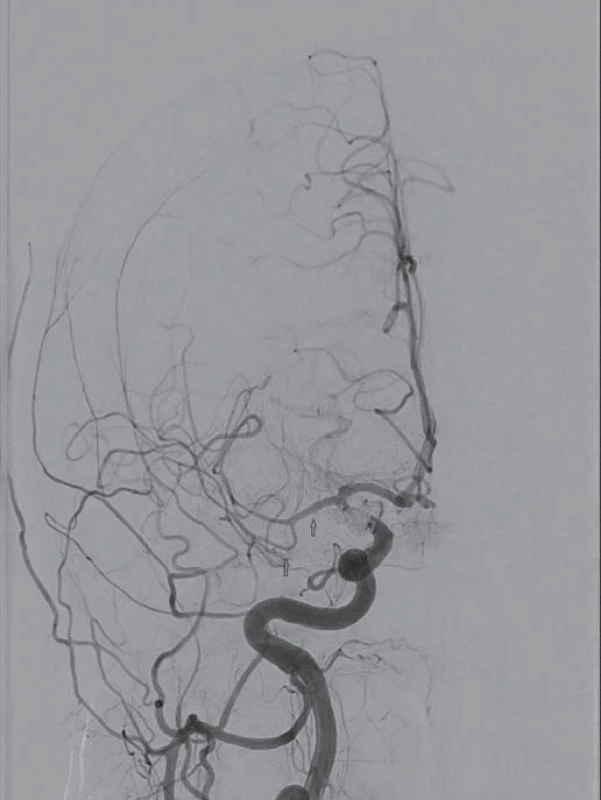 Dvanáctý den po subarachnoideálním krvácení. Náhle vzniklá levostranná hemiplegie. Digitální subtrakční angiografie potvrzuje cerebrální vazospazmy na střední mozkové arterii vpravo (úsek M1, M2, M3).