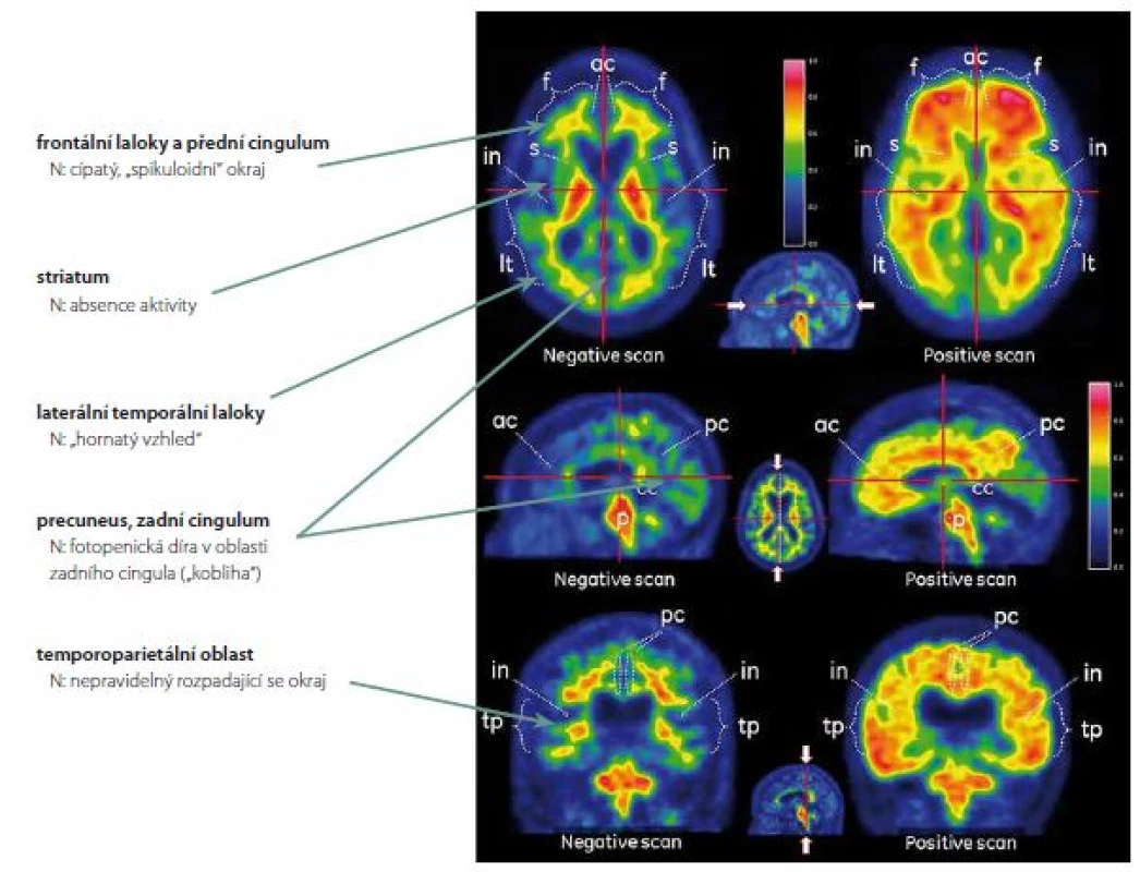 Rozdíl mezi normálním PET skenem mozku (levý sloupec) a skenem zvýšeného mozkového amyloidu (pravý sloupec).
Fig. 1. Difference between normal PET scan of the brain (left column) and a scan with high amyloid content (right column).