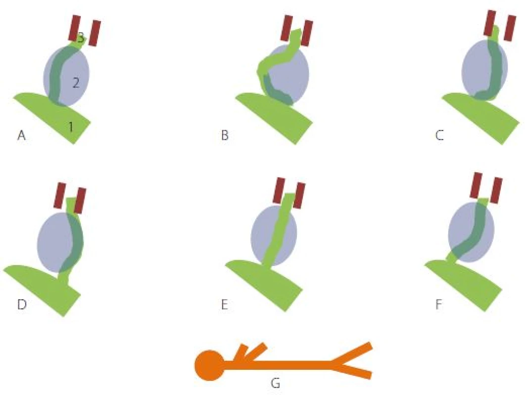 Poloha lícního nervu vůči nádoru: A – ventro-kraniálně, B – rostro-mediálně, C – ventro-kaudálně, D – kaudálně, E – dorzálně, F – ventrálně (ventro-centrálně), G – poloha pacienta; 1) mozkový kmen, 2) tumor, 3) n. VII. ve vnitřním zvukovodu.
Fig. 1. Facial nerve position in relation to the tumour: A – ventro-cranial, B – rostromedial, C – ventro-caudal, D – caudal, E – dorsal, F – ventral (ventro-central), G – patient position; 1 – brainstem, 2 – tumor, 3 – n. VII. in the internal acoustic meatus.