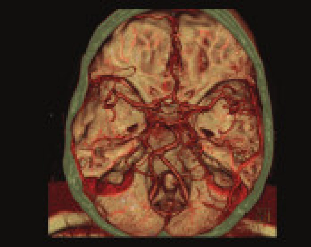 41letá pacientka s náhle vzniklou dysartrií a těžkou levostrannou hemiparézou. CT mozku 1 h 10 min od počátku příznaků ukazuje rozvoj ischemie v povodí a. cerebri media (ACM) vpravo (A). Snížení perfuze – CBF mapa (B), krevního objemu – CBV mapa (C) a prodloužení time to peak – TP mapa (D) v teritoriu ACM vpravo s maximem změn v oblasti bazálních ganglií (jádro ischemie). CTA VRT rekonstrukce ukazuje ACM vpravo v úseku M1 (E).
1 h 30 min od počátku příznaků podán rtPA, výrazné zlepšení neurologického nálezu, po 24 hodinách přetrvává pouze lehká paréza levého ústního koutku. Kontrolní CT mozku po 30 hodinách bez podání kontrastní látky ukazuje dokončený infarkt v oblasti bazálních ganglií a pravém temporálním operkulu (F), známky luxusní perfuze na CBF (G), CBV (H) a TP (I) mapách. CTA VRT rekonstrukce ukazuje volnou ACM vpravo (J).