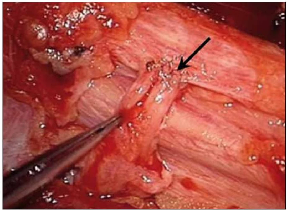 End-to-side anastomóza – laterální sutura n. axillaris (v pinzetě) na n. ulnaris (šipka).