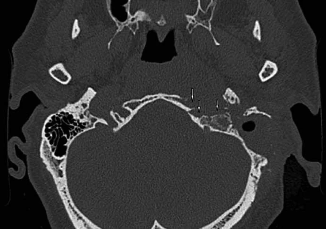 Kazuistika 2 – CT spánkových kostí axiální řezy, stav po antromastoidektomii vlevo.
Osteolytické změny hrotu pyramidy a baze lební – petrookcipitální sutura (vertikální šipky).