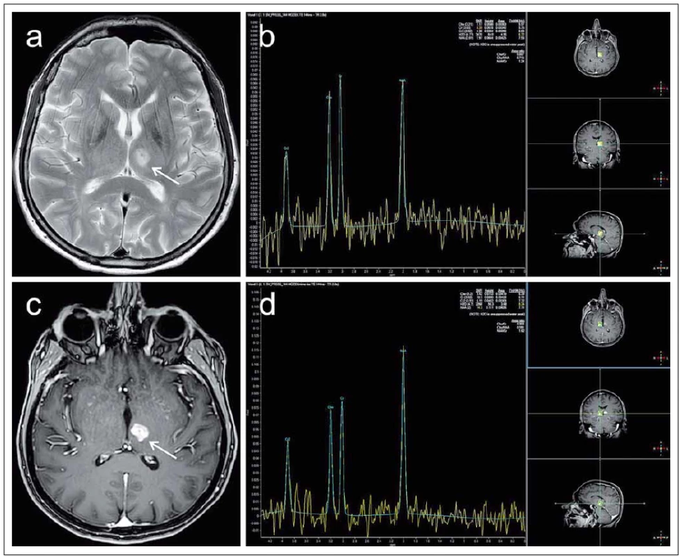 MR vyšetření pacientky ve věku 67 let léčené pro roztroušenou sklerózu od roku 1991 indikované pro zhoršení pravostranné hemiparézy s přechodnou afázii. Pro upřesnění diferenciální diagnózy atypického ložiska levého thalamu (označeno šipkami) bylo provedeno též spektroskopické vyšetření technikou „single-voxel“.
Fig. 8. MRI examination in a 67-year-old female patient treated for multiple sclerosis since 1991, indicated for deterioration of right-side hemiparesis with transient aphasia. To increase the accuracy of differential diagnosis of an atypical focal lesion of the left thalamus (marked with arrows) a spectroscopic “single-voxel” examination was also performed.