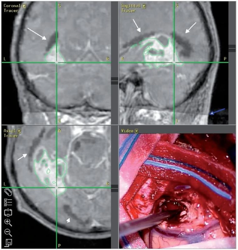 Snímek z neuronavigačního systému, pacient č. 2: černě DTI rekonstrukce optické radiace (bílé šipky), patrná je hranice traktografické datové sady, ta je správně registrovaná k anatomické T1 sadě (modrá šipka).