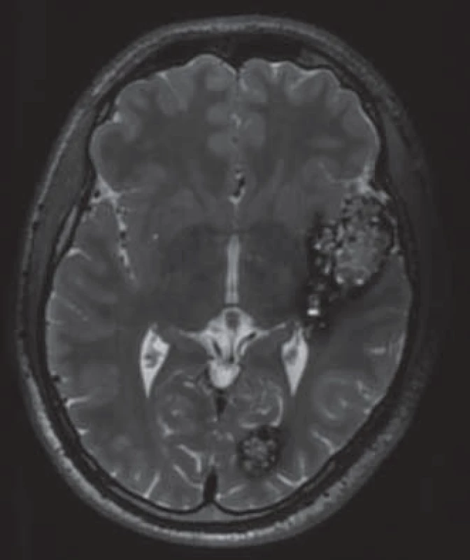 Typický MR obraz kavernomu v T2 váženém obraze.
