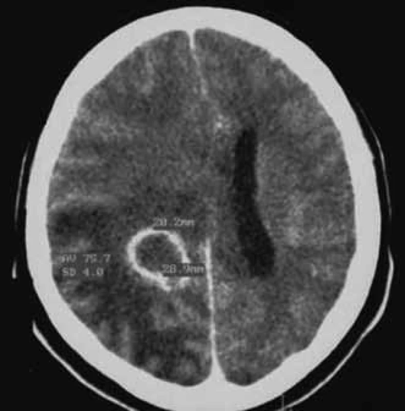 CT po podání kontrastní látky ukazuje kulovité ložisko (20 × 28 × 15 mm) s enhancujícím prstenčitým lemem v hloubce pravé mozkové hemisféry. Kolaterální edém způsobuje středočárový přetlak 13 mm.