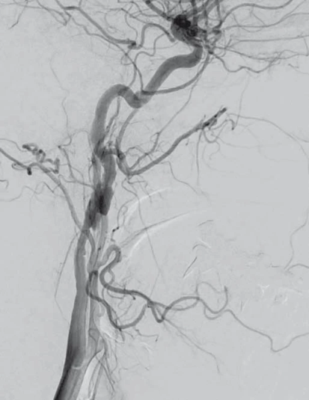 Digitální subtrakční angiografie.
Disekce pravé a. carotis interna.
Fig. 2. Digital subtraction angiography.
Dissection of the right internal carotid artery.