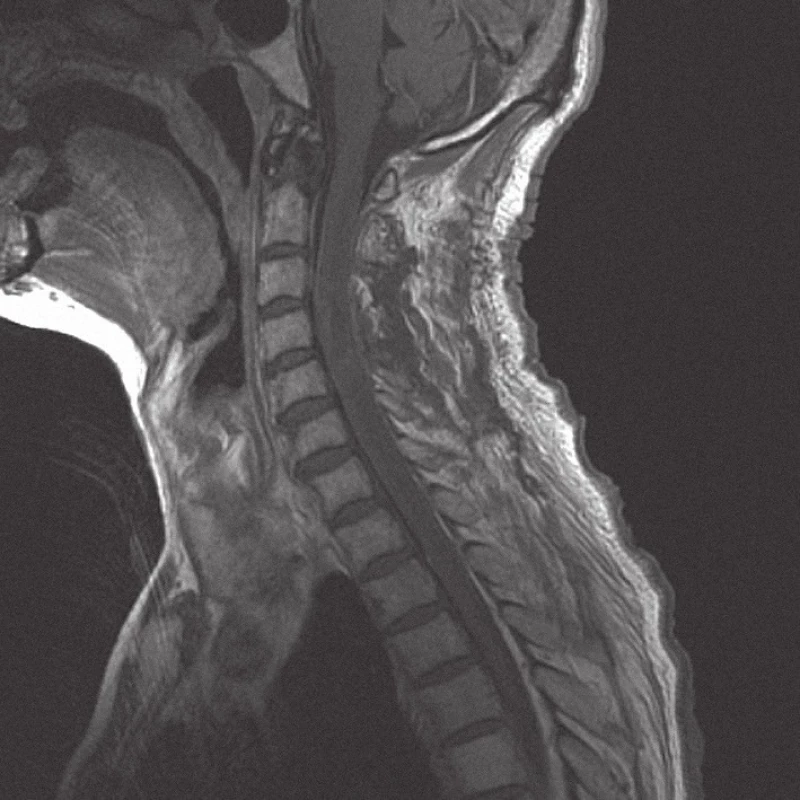 MRI krční páteře v sagitální rovině, v T1 módu s kontrastem, dva dny po operaci, bez známek tumoru.