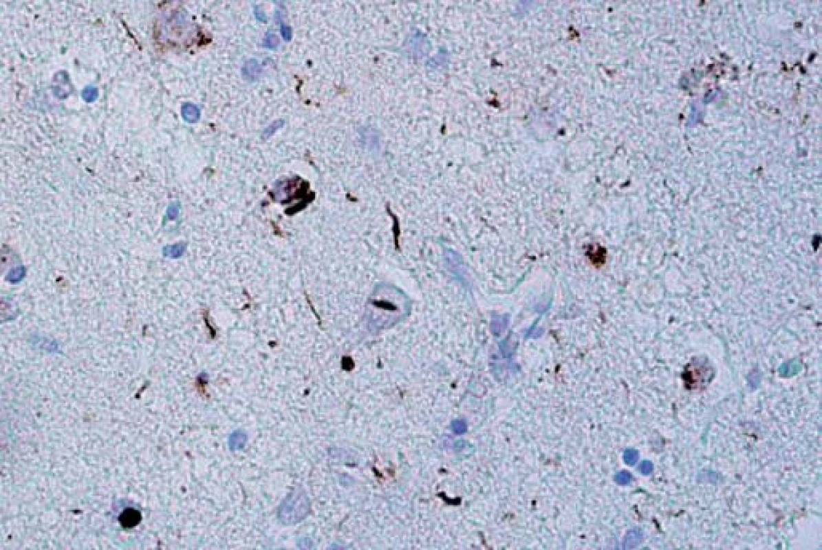 Neuronální intranukleární inkluze (NII) ve frontálním kortexu v imunohistochemickém barvení P-TDP-43. Typ A.
Fig. 4. Neuronal intranuclear inclusions (NII) on the frontal cortex of immunohistochemical staining of P-TDP-43. Type A.