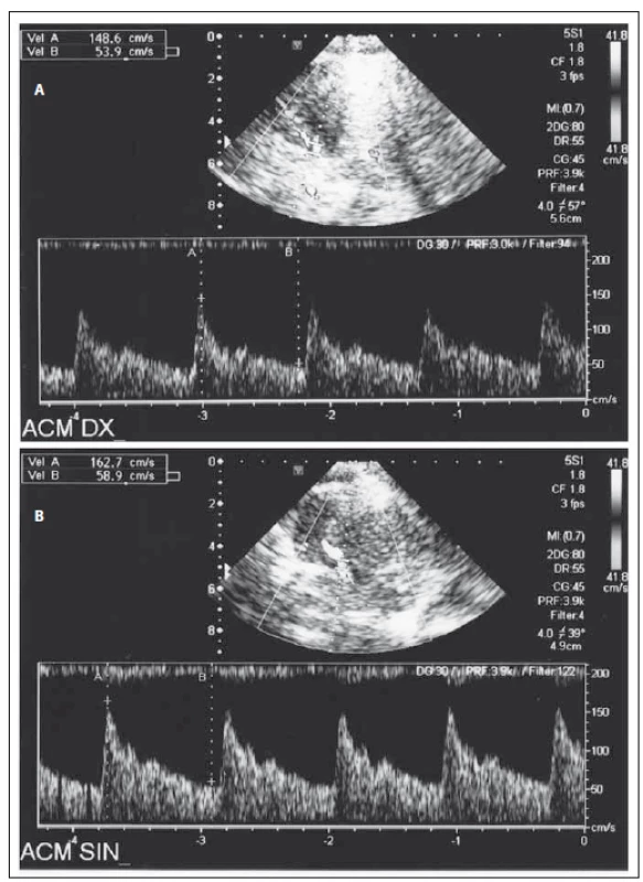Transkraniální dopplerovská ultrasonografie 14. den od rozvoje obtíží: vazospazmy lehkého stupně v arteria cerebri media oboustranně vpravo (a), vlevo (b).
Fig. 1. Transcranial Doppler ultrasonography on the 14&lt;sup&gt;th&lt;/sup&gt; day after onset of symptoms: mild vasospasms in both right (a), left middle cerebral arteries (b).