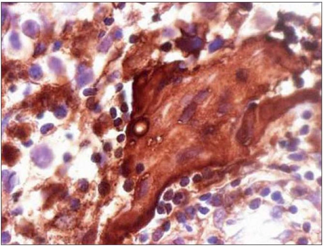 Imunohistochemické vyšetření nádoru: pozitivní průkaz syncytiotrofoblastu produkujícího hCG (zvětšení 400×).