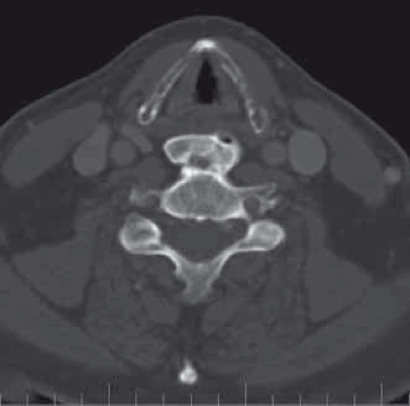 Předoperační CT, axiální snímek (kazuistika 1).
Fig. 3. Preoperative CT, axial image (a case report 1).