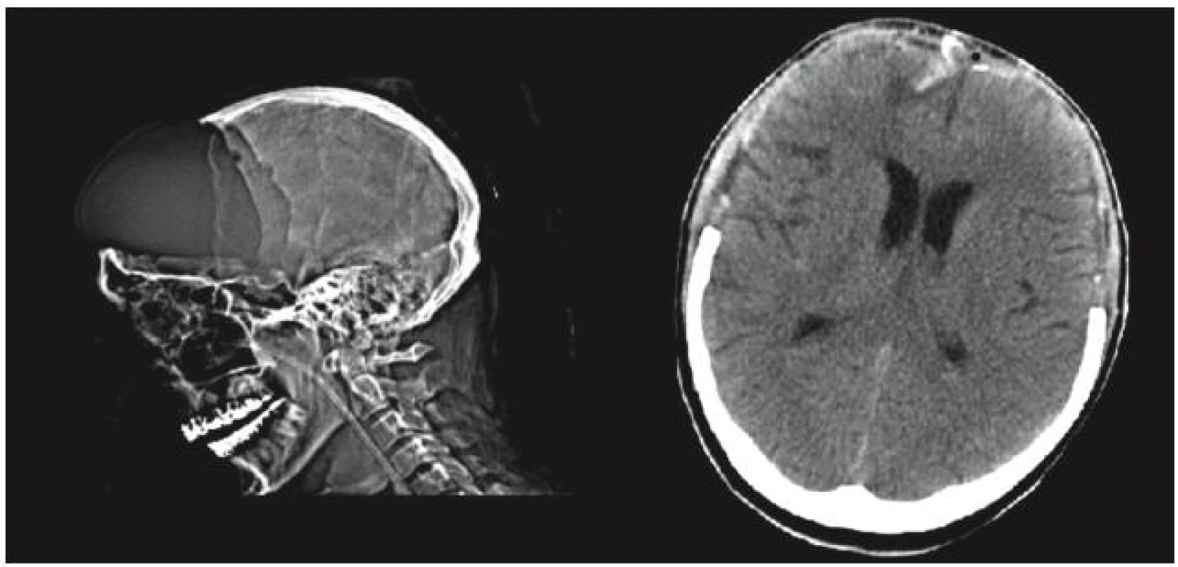 Rozsah bifrontální kraniektomie na bočním snímku lebky a CT. Je zde patrná expandující mozková tkáň prominující až 3 cm nad původní polohu v nitrolebí.