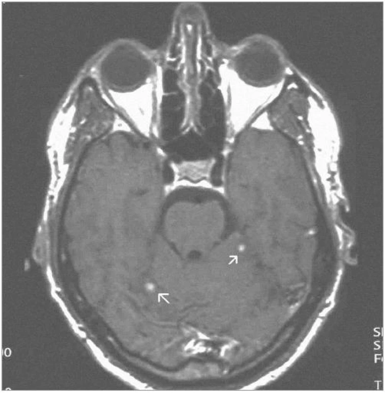 Stejná ložiska 3 roky po ozáření – kontrolní MRI – SE T1-vážený obraz po aplikaci kontrastní látky – s jejich patrnou regresí (2004).