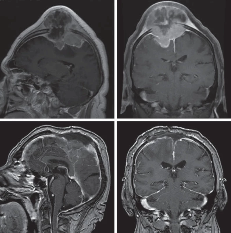 Před- a pooperační snímky pacienta s anaplastickým meningeomem parietálně oboustranně.