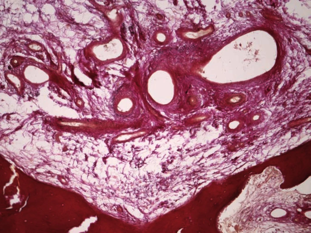 Mikrofotografie venózního typu hemangiomu.