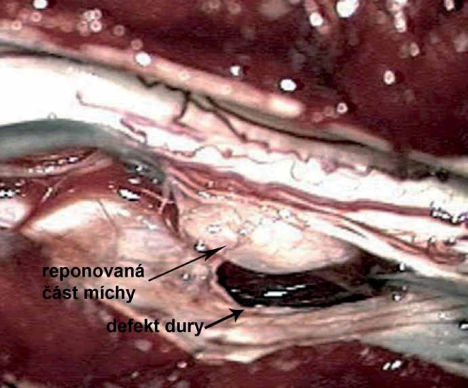 Peroperační foto zachycující durální defekt a herniovanou část míchy po repozici.
