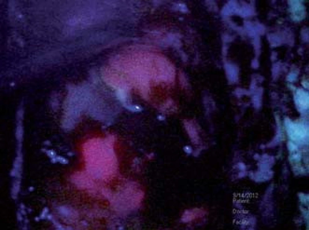 Peroperační fotografie zachycující dno resekční dutiny se solidní rezidulání porcí jasné purpurově červené fluorescence vlevo dolů, okrsek slabší růžové fluorescence vpravo nahoře reprezentuje „okraj“ nádoru.