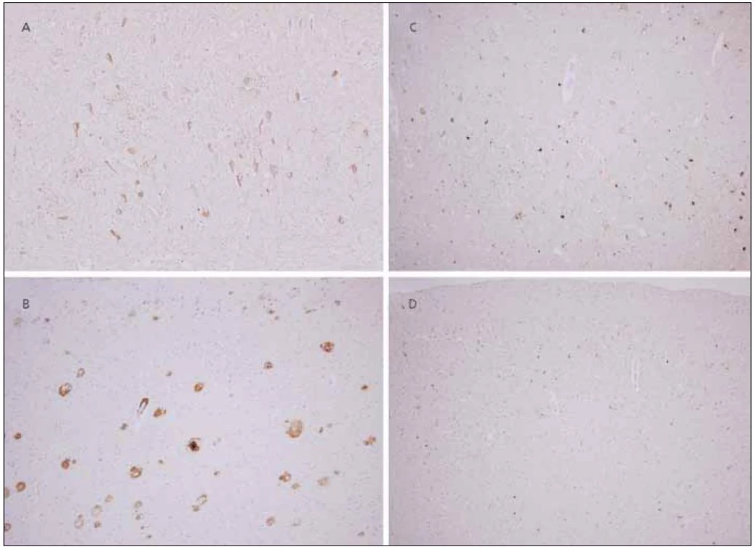 Neuropatologie.
Neuropatologický nález změn typických pro Alzheimerovu nemoc: výrazné postižení parietálního kortexu v rámci AN : četná neurofibrilární klubka pozitivní v imunohistochemické reakci s protilátkou proti hyperfosforylované formě tau proteinu (a) a vysoký počet senilních plak, převážně „zralého“ typu, s imunohistochemickou pozitivitou protilátky proti amyloid-ß peptidu (b). Původní zvětšení 200×.
Tau inkluze: Značná část inkluzí hyperfosforylovaného tau proteinu v parietální kůře je pozitivních v reakci s protilátkou proti 4R (c),
avšak místy je zřetelná převaha 3R pozitivit (d). Změny typické pro CBD chybí. Původní zvětšení 200×.