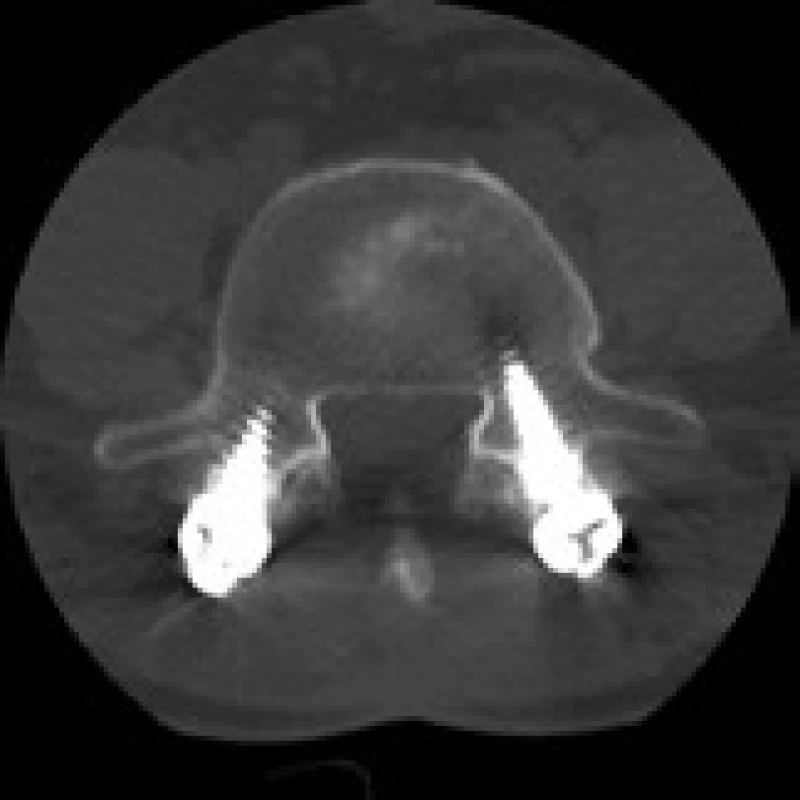 CT snímek šest měsíců po doplnění zadní transpedikulární fixace L4–5 pro selhání ALIF stand-alone (Visios) u stejného pacienta. Vyšetření prokazuje vymizení cystických změn na styčné ploše obratlového těla L5 a implantátu. Axiální sken.
