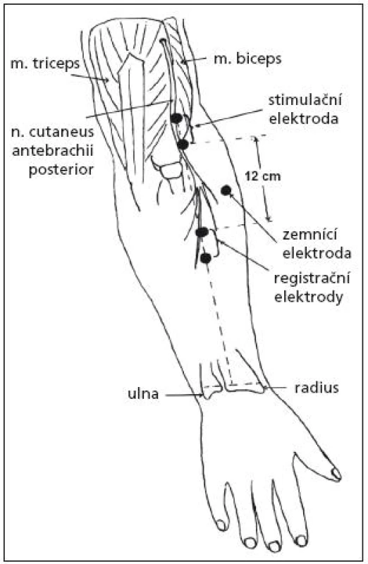 Schéma senzitivní neurografie nervus cutaneus antebrachii posterior [7].
