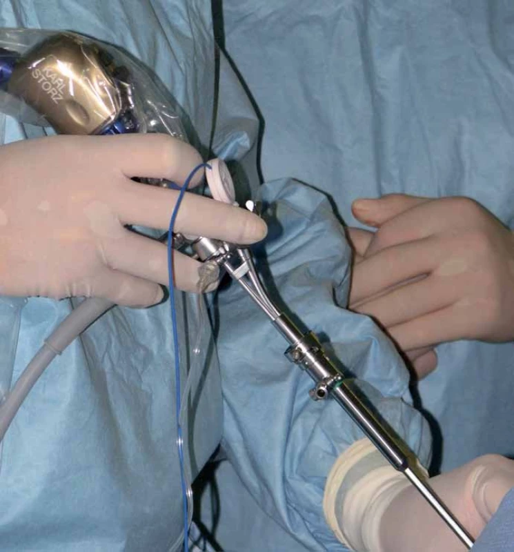 Navigovaný mandrén zasunutý v pracovním kanálu endoskopu.