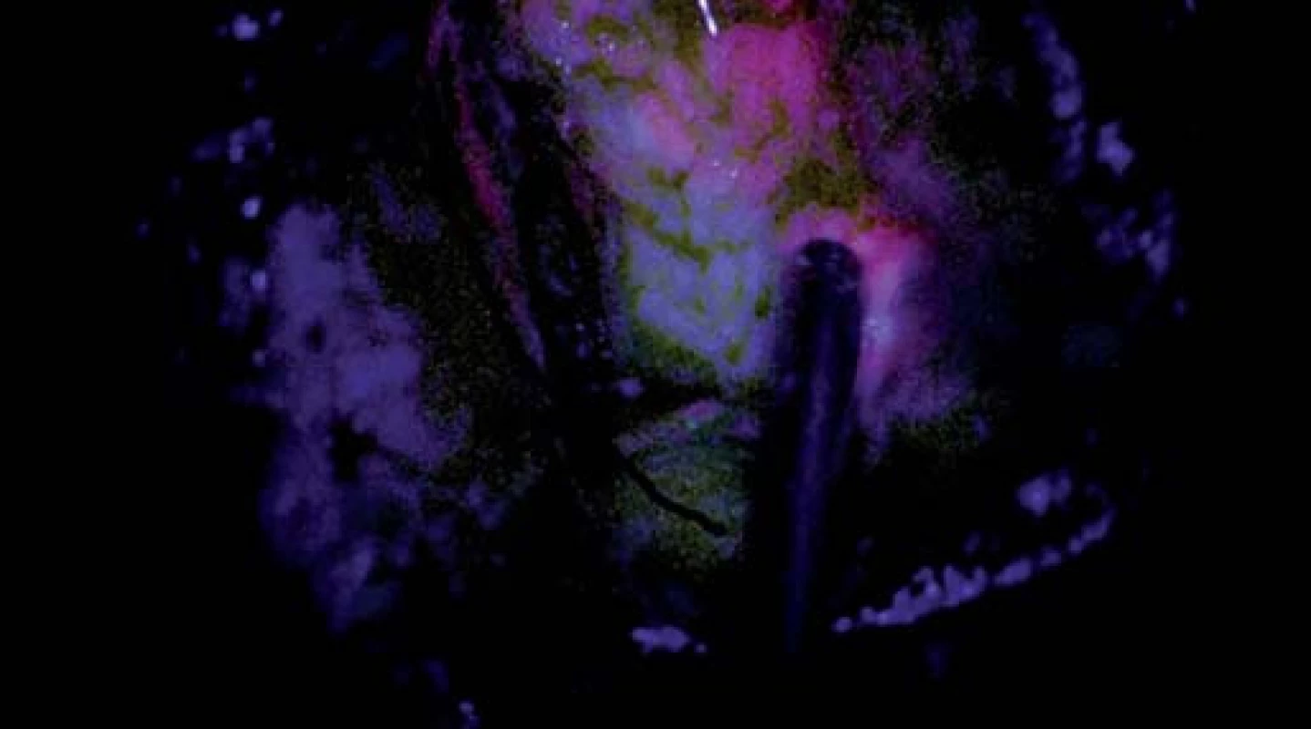 Fotografie zachycující resekční dutinu se slabě růžovou fluorescencí na horním okraji snímku (zóna 2), pod ní je oblast parenchymu již bez viditelné fluorescence (zóna 3).
Fig. 5. Snapshots depicting the resection cavity with light pink fluorescence at the upper edge of the image (zone 2), the parenchyma below has no visible fluorescence (zone 3).