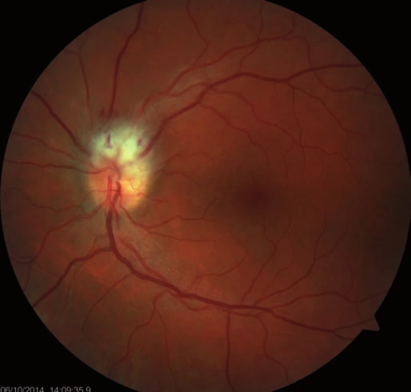 Fundoscopy of the left eye: ischemic edema in the upper half of the optic nerve disc – the first visit.