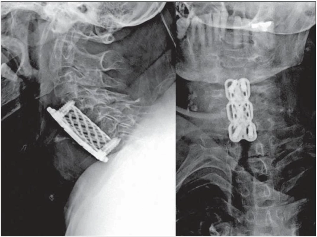 Radiologický nález po první operaci, kde je patrná ztráta ukotvení kraniálních šroubů v těle C4 a společně s tím ventrální dislokace dlahy a koše. Dále můžeme sledovat prohloubení krční lordózy.