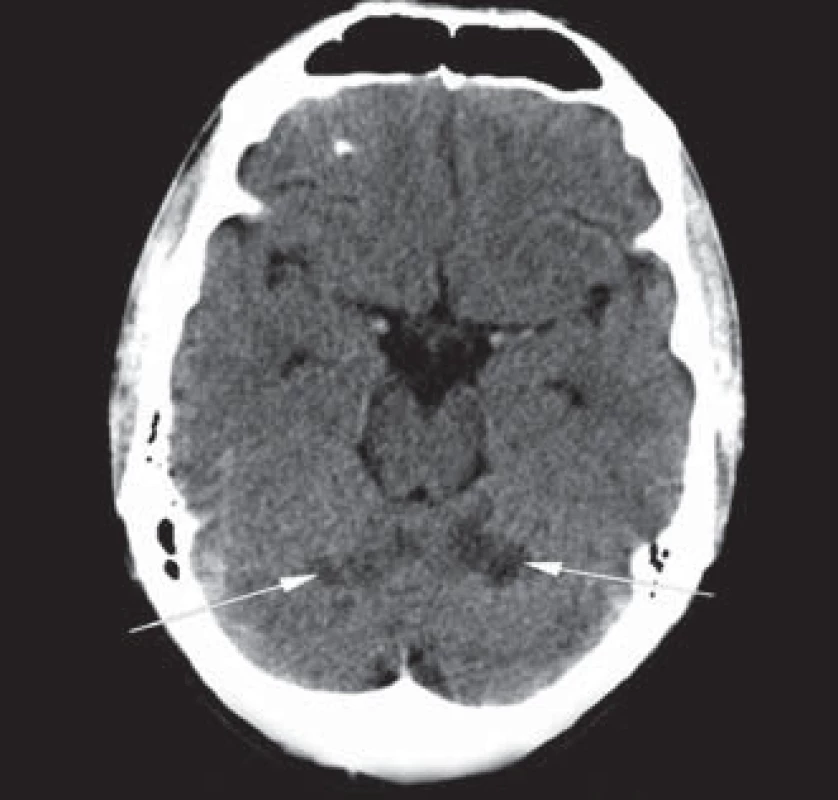 Hypodezní ložiska v obou mozečkových hemisférách na vstupním CT mozku (šipky).