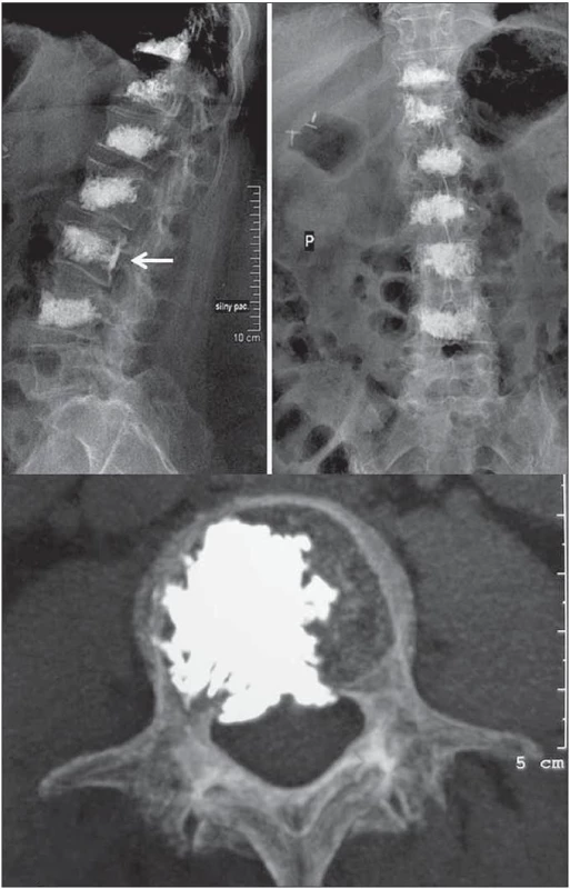 Augmentace obratlového těla L3 při stařecké osteoporóze byla komplikována dorzálním subligamentózním únikem PMMA.
Objemově i klinicky se jedná o nález bezvýznamný.