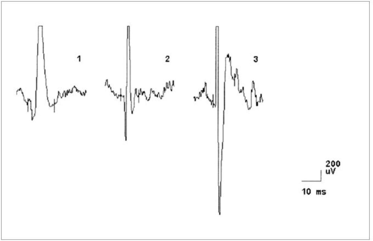 EMG nález při vyšetření musculus biceps brachii vlevo u pacienta č. 4, dokumentující změny v obraze motorických jednotek neurogenního typu (vysoká amplituda MUP, polyfázie).