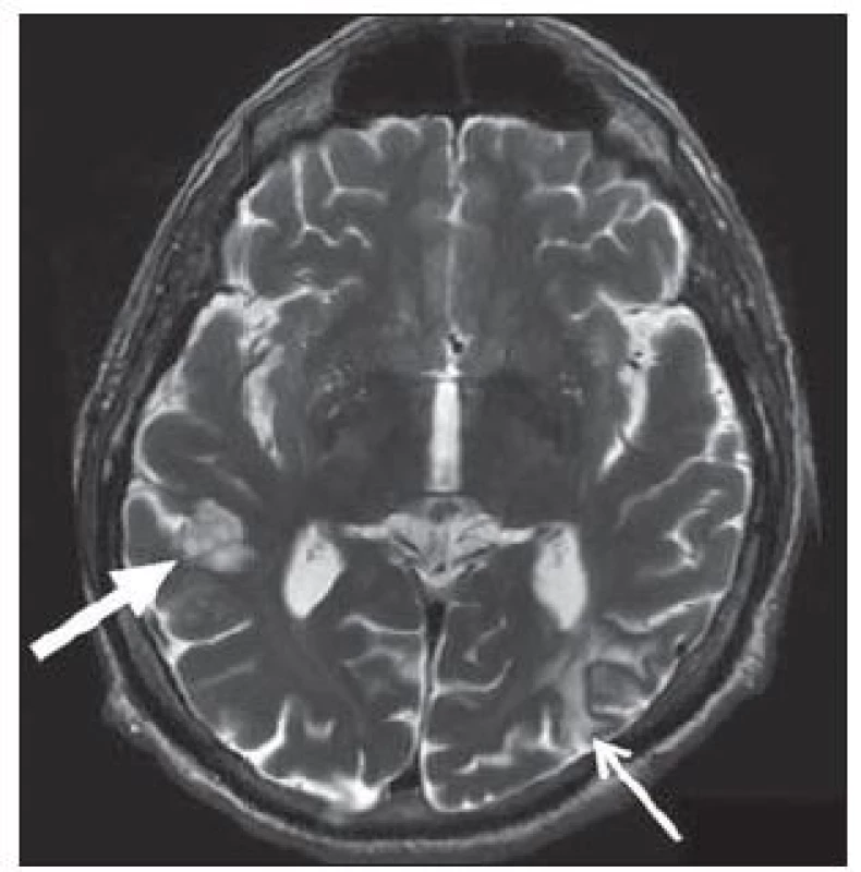Dysembryoplastický neuroepiteliální tumor.