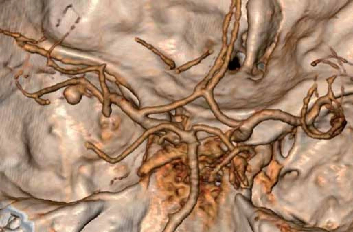 CT angiografie v 3D rekonstrukci. Představa výdutě v oblasti M2/3 trvá.