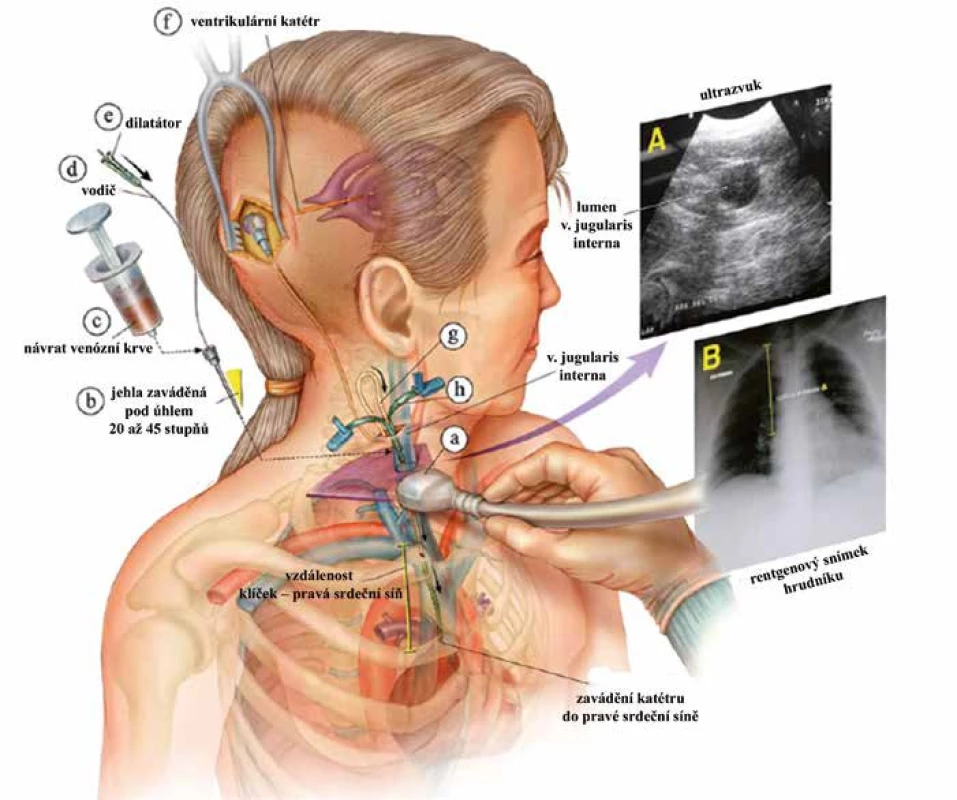 Schéma implantace VAS s využitím ultrazvukové a rentgenové kontroly (upraveno) [91].