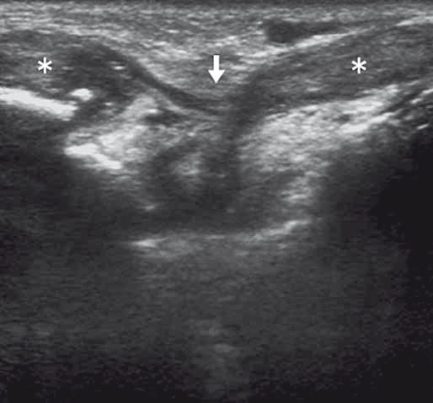 Ruptura extenzoru zápěstí (bílá šipka) klinicky imitující parézu nervus radialis. 
Fig. 5. Wrist extensor tendon rupture (white arrow) clinically mimicking radial nerve palsy.