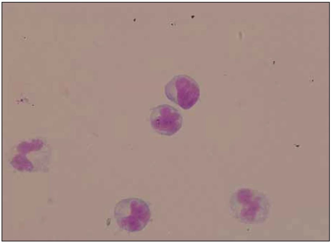 Likvor – maligní buňky s laločnatými jádry.