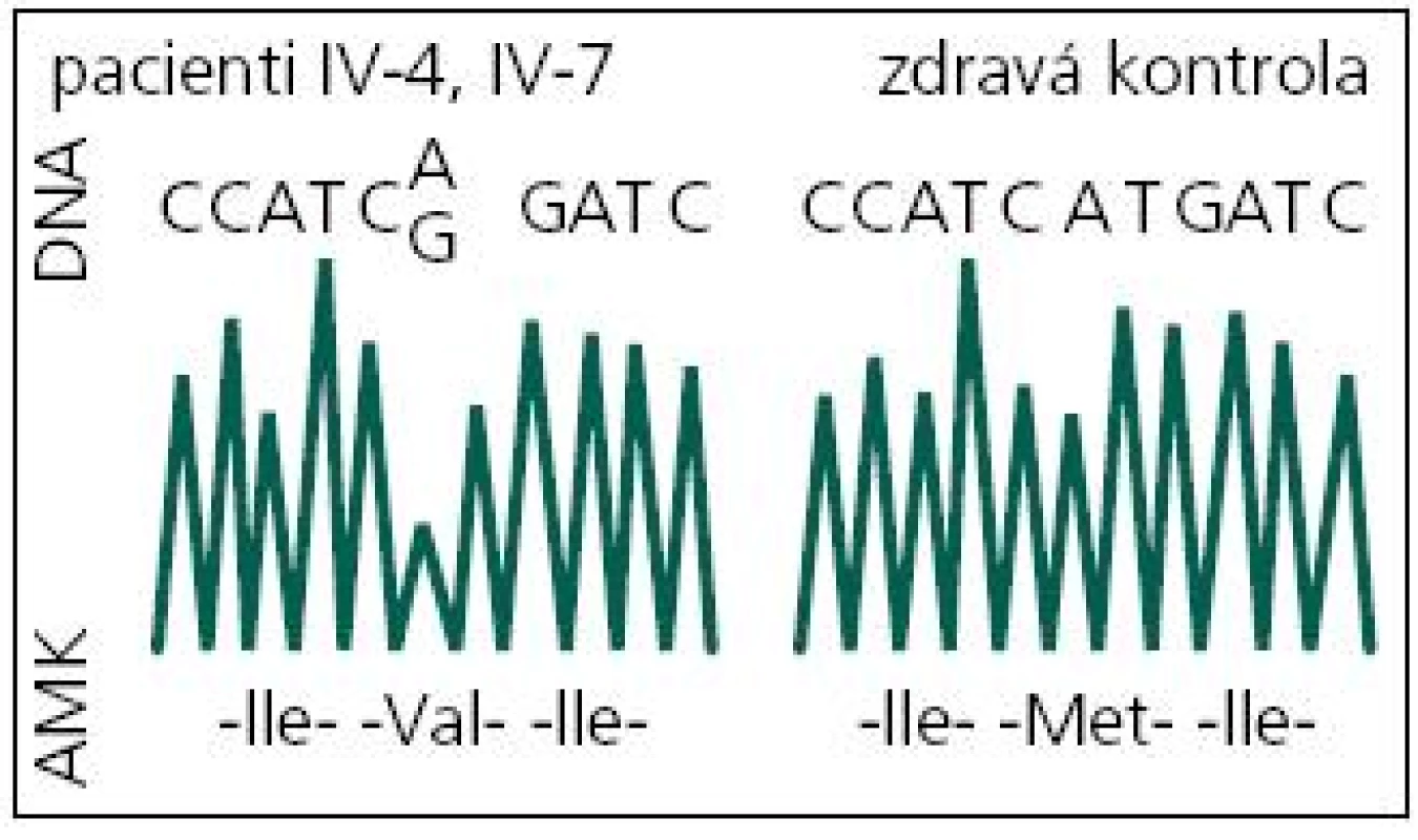 DNA sekvence části exonu 5 genu PSEN1 s mutací c.415A&gt;G (p.M139V) a bez ní.
DNA: deoxyribonukleová kyselina; A: adenin; C: cytosin; G: guanin; T: tymin; AMK: aminokyselina; Ile: izoleucin; Val: valin; Met: metionin.