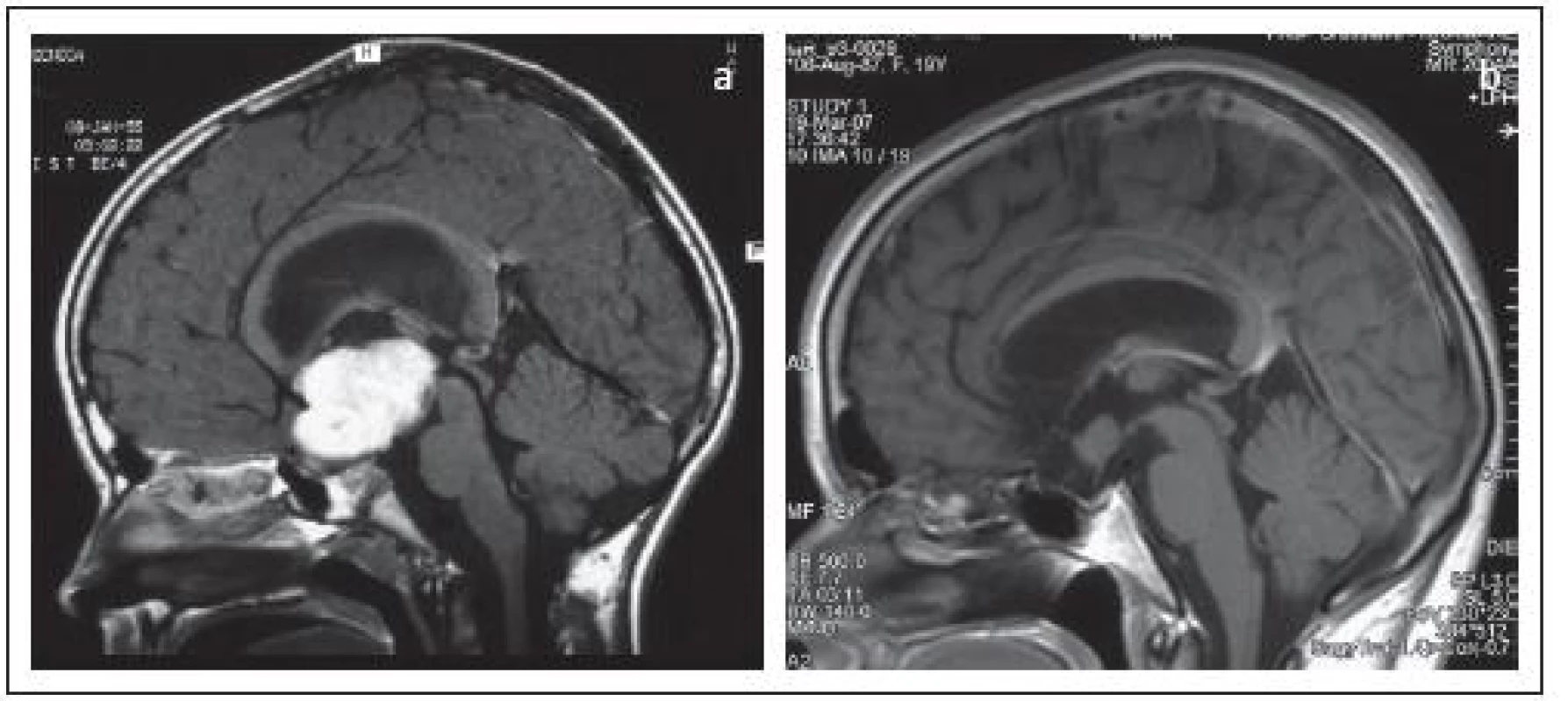 Pilocytárny astrocytóm chiazmy a hypotalamu u 6-ročného dievčatka (a). b – stacionárne reziduum tumoru o 14 rokov po parciálnej resekcii tumoru cez lamina terminalis a externej rádioterapii (30Gy).
