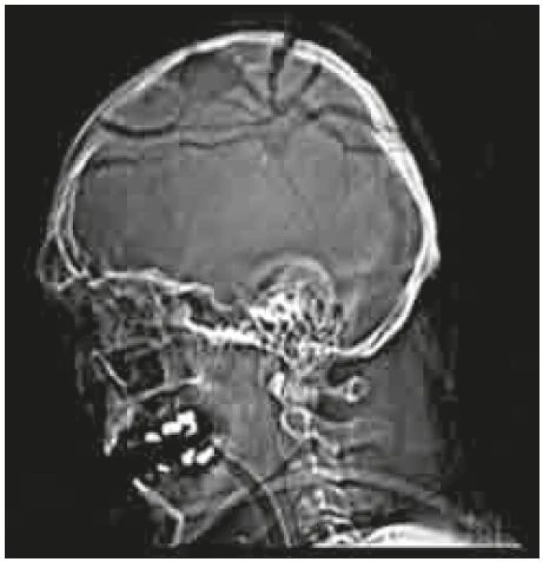 Průstřel hlavy a mozku v oblasti parietálních laloků.
CT mozku – boční topogram.