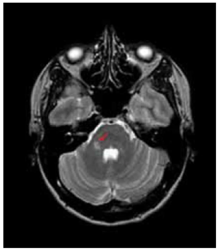 T2 TSE, ložisko v zadní jámě lební v typické oblasti pravého mozečkového pedunklu.