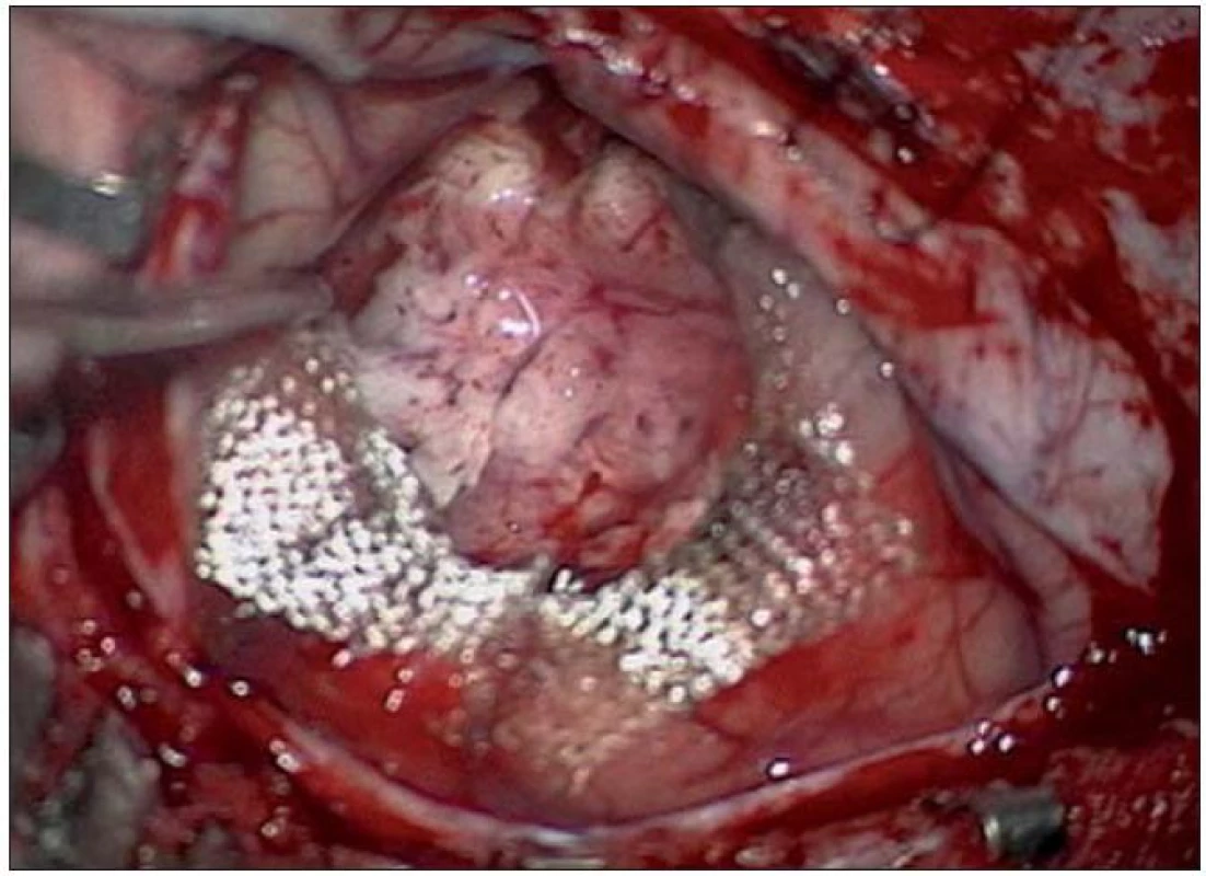 Radikální resekce tumoru peroperačně s Surgicelem na spodině.