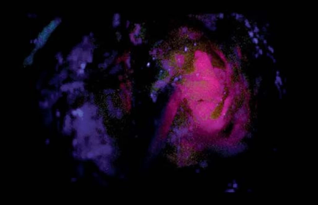 Fotografie zachycující jasně intenzivní fluorescenci nádoru (zóna 1).
Fig. 4. Snapshots depicting bright tumour fluorescence (zone 1).