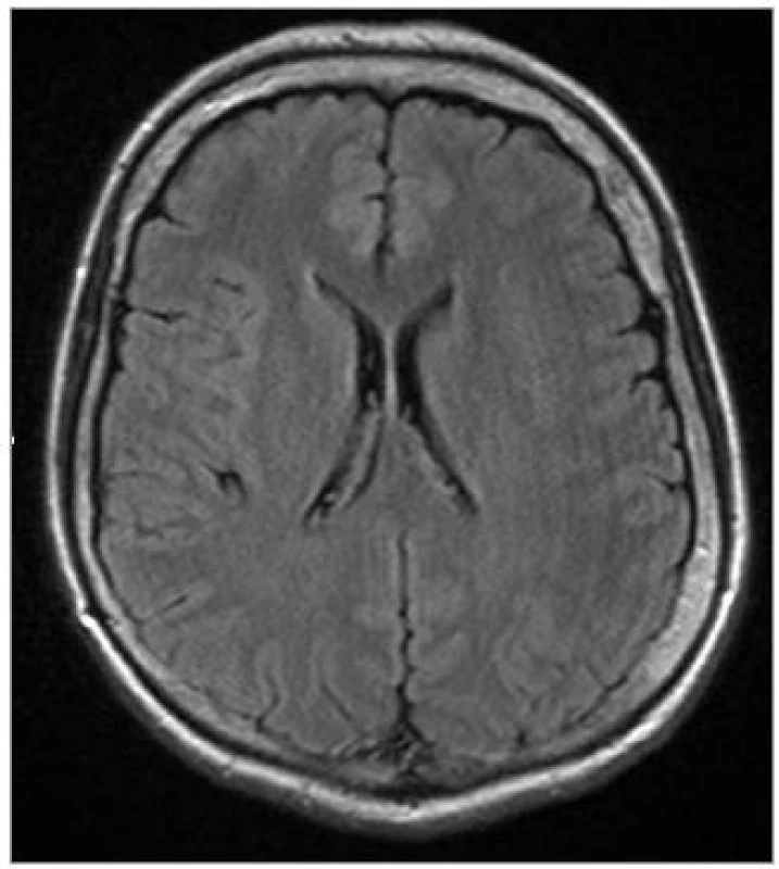 Transverzální MRI scan FLAIR sekvence 52leté ženy trpící parkinsonským syndromem s kognitivním deficitem a syndromem ALS, s nálezem počínající atrofie frontálních a temporálních laloků (pacientka č. 1).